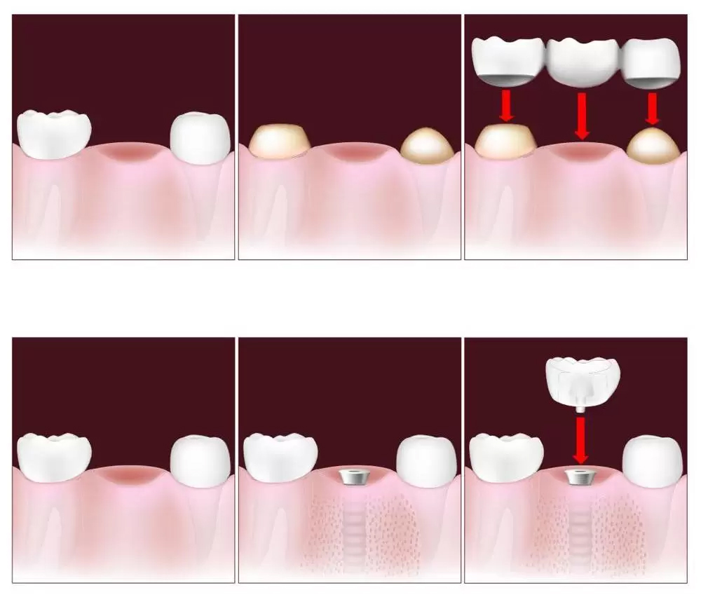 歯を失ったらインプラントとブリッジはどちらがおすすめ？