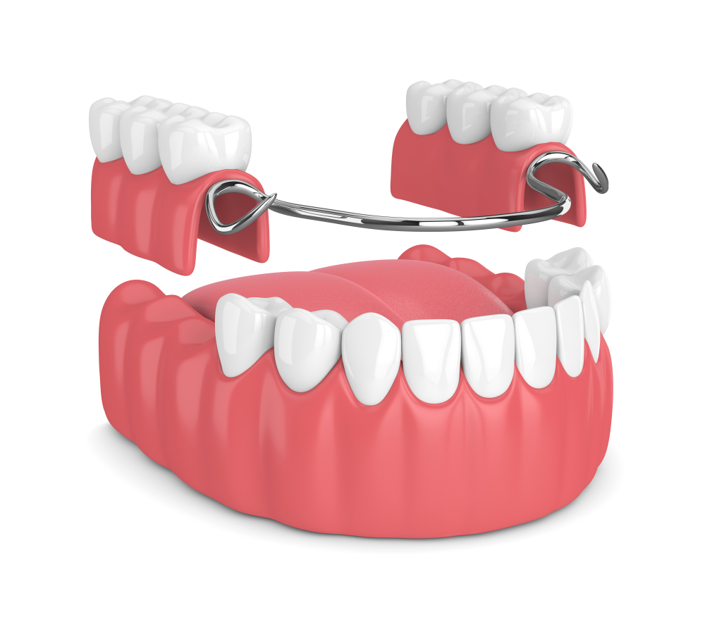 入れ歯のメリット、デメリットと適応例