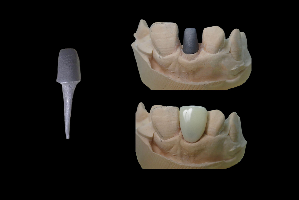 セラミック歯に欠かせない歯の土台の役割と種類