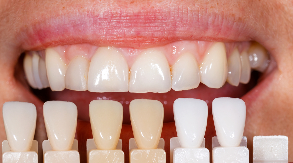 ホワイトニングで歯が白くなるメカニズムは？