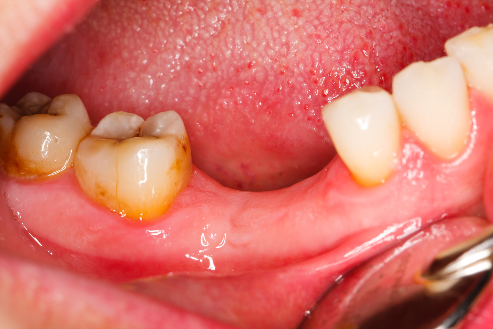 歯を失った時の3つの治療法