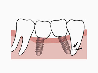 天然歯への傷害