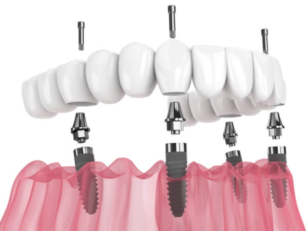 オールオン4（オールオンフォー）の治療の流れ 本歯装着（仮歯と比較し、高度、審美的に高い）
